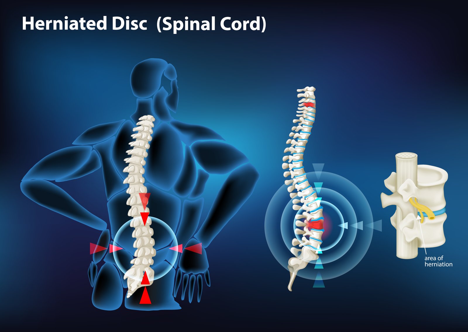 Spine Surgery by Dr Neelesh Damani
